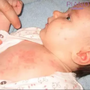 آلرژی در کودکان 