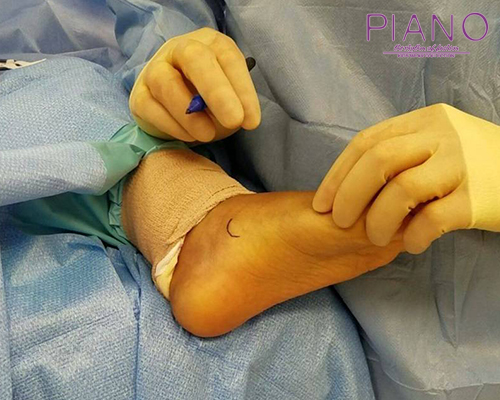 2_ عمل جراحی برای درمان صافی کف پای کودکان: