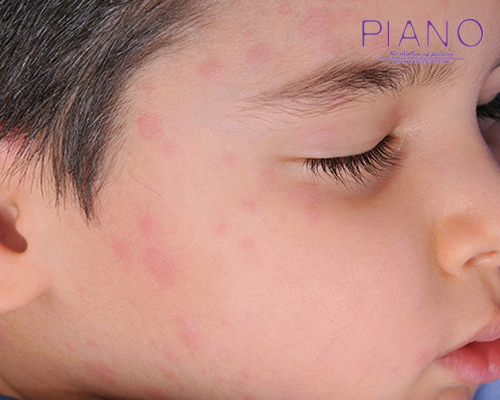 علائم و نشانه های کهیر پوستی در کودکان