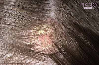موهای غیر قابل کنترل بزرگترین مشکلات پوستی در تابستان