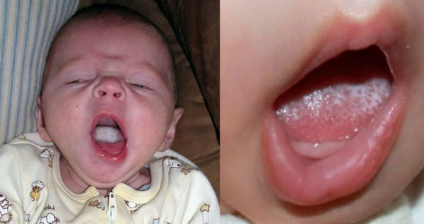 تفاوت بین برفک دهان نوزادان و دلمه شیر